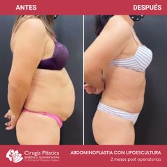 Abdominoplastia - Dr. Emmanuel Manavela Chiapero