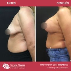 Mastopexia - Dr. Emmanuel Manavela Chiapero