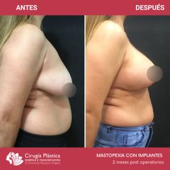 Mastopexia - Dr. Emmanuel Manavela Chiapero