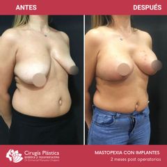 Mastopexia - Dr. Emmanuel Manavela Chiapero
