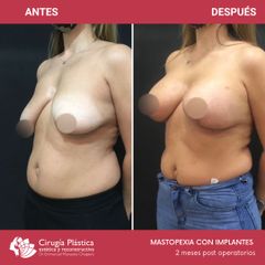 Mastopexia - Dr. Emmanuel Manavela Chiapero