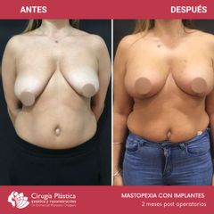 Mastopexia - Dr. Emmanuel Manavela Chiapero