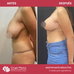 Reducción de mamas - Dr. Emmanuel Manavela Chiapero