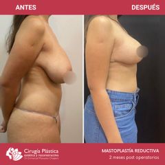 Reducción de mamas - Dr. Emmanuel Manavela Chiapero