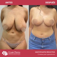 Reducción de mamas - Dr. Emmanuel Manavela Chiapero