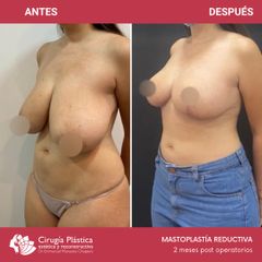 Reducción de mamas - Dr. Emmanuel Manavela Chiapero
