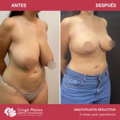 Reducción de mamas - Dr. Emmanuel Manavela Chiapero