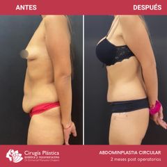 Abdominoplastia - Dr. Emmanuel Manavela Chiapero