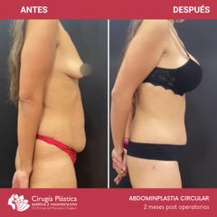Abdominoplastia - Dr. Emmanuel Manavela Chiapero