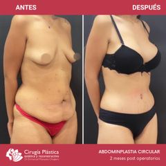 Abdominoplastia - Dr. Emmanuel Manavela Chiapero