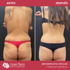Abdominoplastia - Dr. Emmanuel Manavela Chiapero