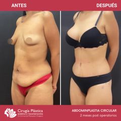 Abdominoplastia - Dr. Emmanuel Manavela Chiapero