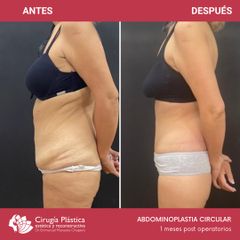 Abdominoplastia - Dr. Emmanuel Manavela Chiapero