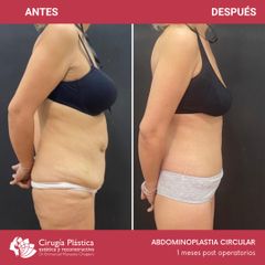 Abdominoplastia - Dr. Emmanuel Manavela Chiapero