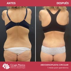Abdominoplastia - Dr. Emmanuel Manavela Chiapero