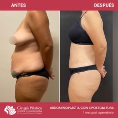 Abdominoplastia - Dr. Emmanuel Manavela Chiapero