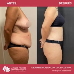 Abdominoplastia - Dr. Emmanuel Manavela Chiapero