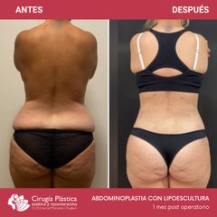 Abdominoplastia - Dr. Emmanuel Manavela Chiapero