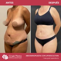 Abdominoplastia - Dr. Emmanuel Manavela Chiapero