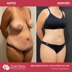 Abdominoplastia - Dr. Emmanuel Manavela Chiapero