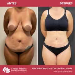 Abdominoplastia - Dr. Emmanuel Manavela Chiapero