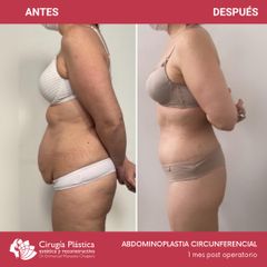 Abdominoplastia - Dr. Emmanuel Manavela Chiapero