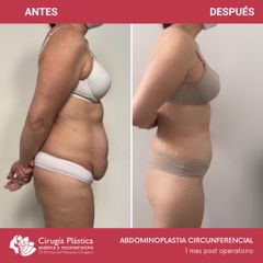 Abdominoplastia - Dr. Emmanuel Manavela Chiapero