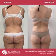 Abdominoplastia - Dr. Emmanuel Manavela Chiapero