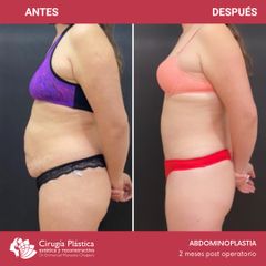 Abdominoplastia - Dr. Emmanuel Manavela Chiapero