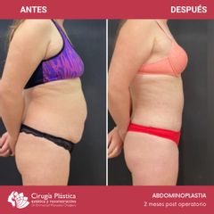 Abdominoplastia - Dr. Emmanuel Manavela Chiapero