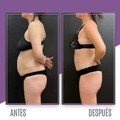 Abdominoplastia - Dr. Emmanuel Manavela Chiapero