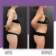 Abdominoplastia - Dr. Emmanuel Manavela Chiapero