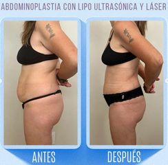 Liposucción ultrasonica y láser  + Abdominoplastia - Dr. Emmanuel Manavela