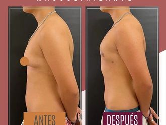 Reasignación de sexo antes y después - 869986