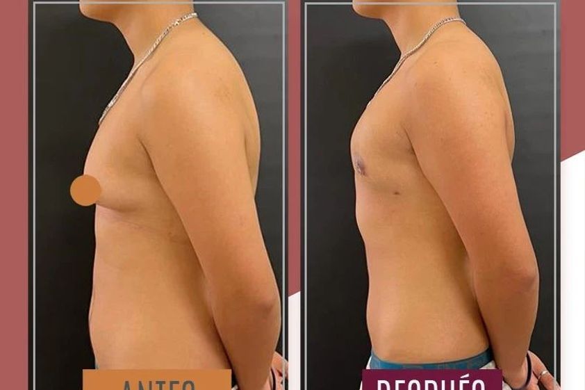 Reasignación de sexo antes y después - 869986