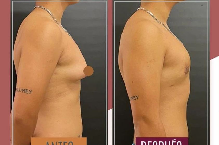 Reasignación de sexo antes y después - 869987