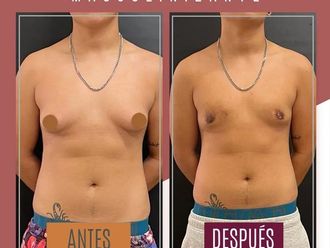 Reasignación de sexo antes y después - 869988