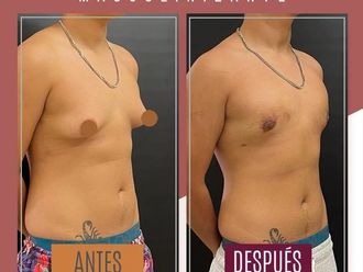 Reasignación de sexo antes y después - 869989