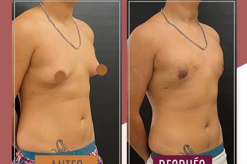 Reasignación de sexo antes y después - 869989