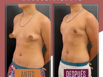 Reasignación de sexo antes y después - 869990