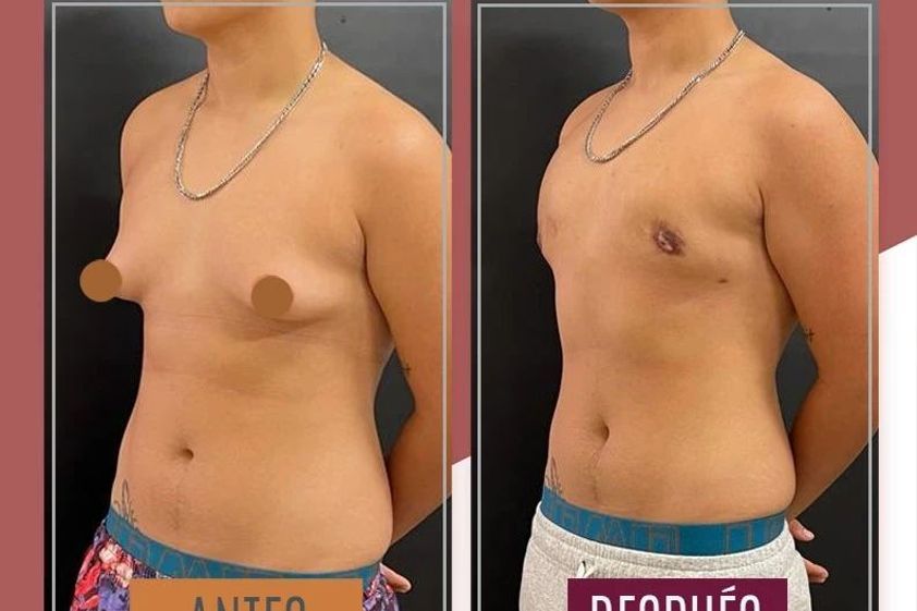 Reasignación de sexo antes y después - 869990