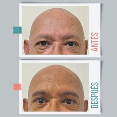 Blefaroplastia - Dr. Emmanuel Manavela Chiapero