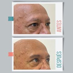 Blefaroplastia - Dr. Emmanuel Manavela Chiapero