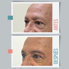 Blefaroplastia - Dr. Emmanuel Manavela Chiapero