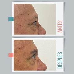 Blefaroplastia - Dr. Emmanuel Manavela Chiapero