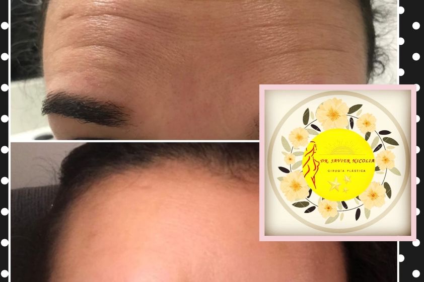 Botox antes y después - 661892