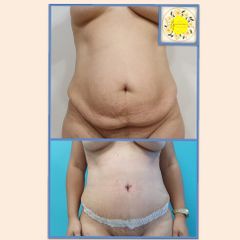 Dr. Javier Nicolía - Lipoabdominoplastia