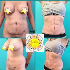 Lipo -Marcación HD + Mini - Abdominoplastia