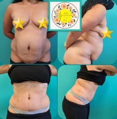 Lipo-Abdominoplastia - Dr. Javier Nicolía