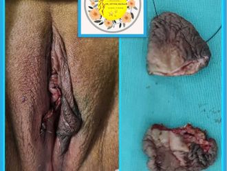 Vaginoplastia antes y después - 742008